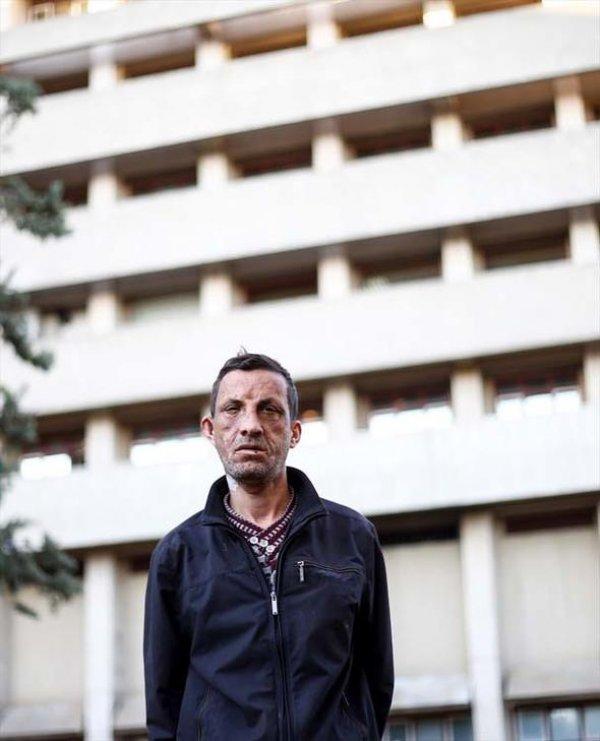 Türkiye'nin ilk yüz nakli olan hastası: Rüya gibi