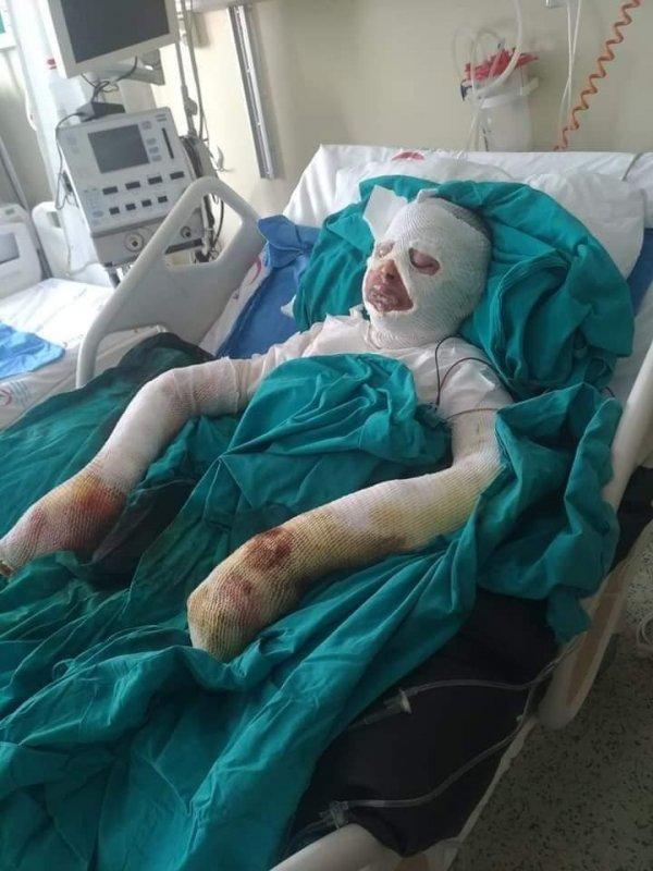 Lise öğrencisi bitlerden kurtulmak isterken tutuştu