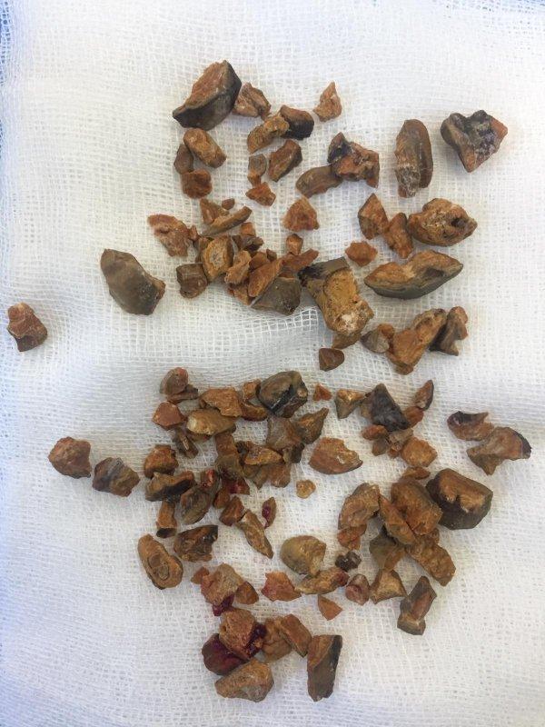 Bir hastadan, 152 parça taş çıkartıldı