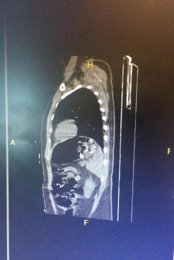 Midesinde 192 gram eroin bulundu
