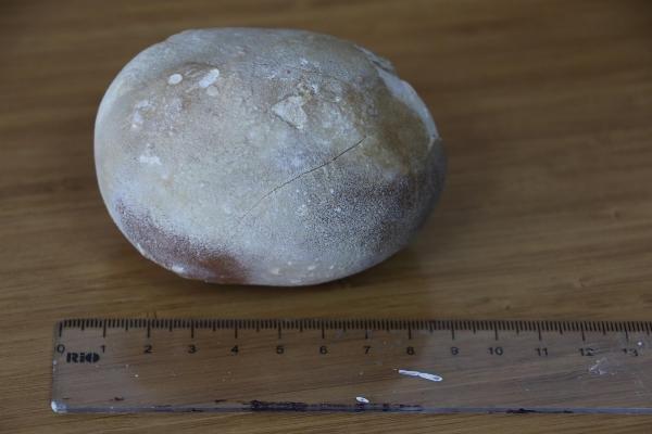 Samsun'da 37 yıllık doktoru şaşırtan taş