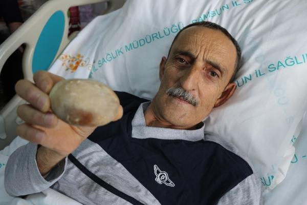 Samsun'da 37 yıllık doktoru şaşırtan taş