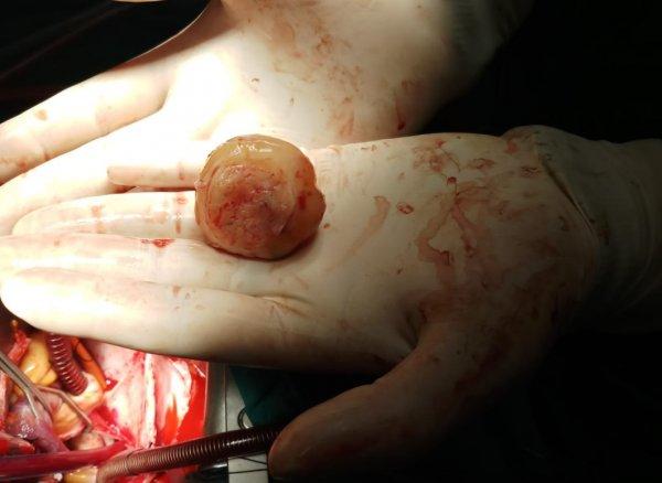 Talihsiz kadının kalbinden kitle çıkarıldı