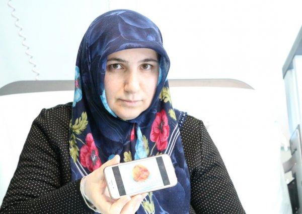 Talihsiz kadının kalbinden kitle çıkarıldı