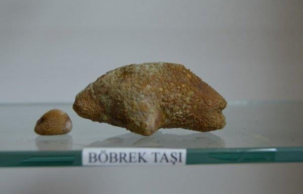 Osmaniye Devlet Hastanesi'nde böbrek taşları sergileniyor