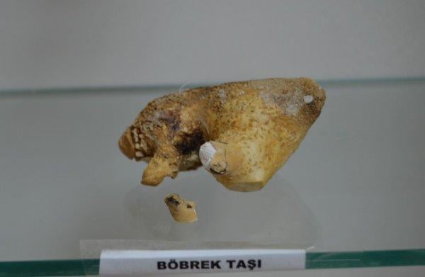 Osmaniye Devlet Hastanesi'nde böbrek taşları sergileniyor