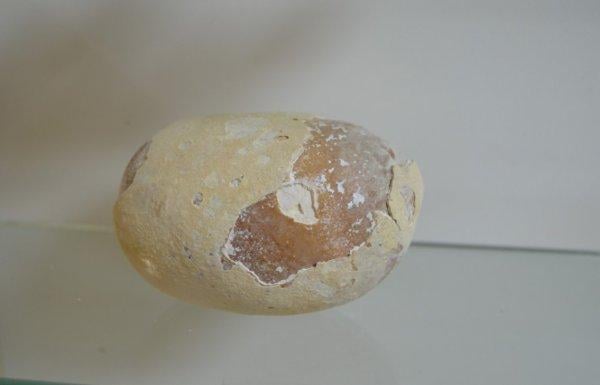 Osmaniye Devlet Hastanesi'nde böbrek taşları sergileniyor