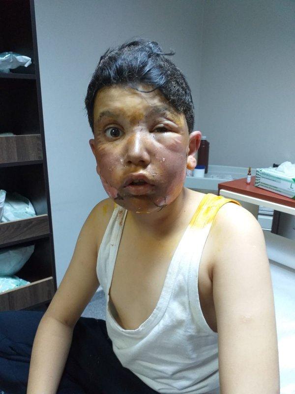 Erzurum'da 11 yaşındaki çocuğun yüzü yandı