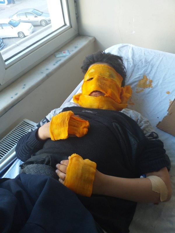 Erzurum'da 11 yaşındaki çocuğun yüzü yandı