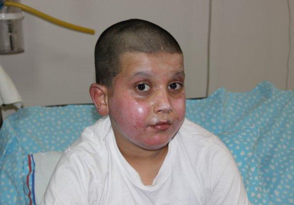 Erzurum'da 11 yaşındaki çocuğun yüzü yandı