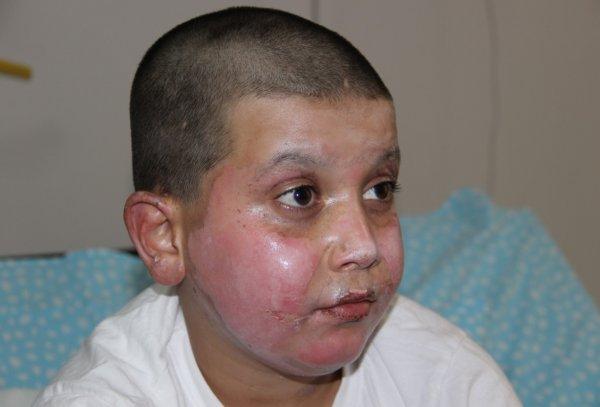 Erzurum'da 11 yaşındaki çocuğun yüzü yandı