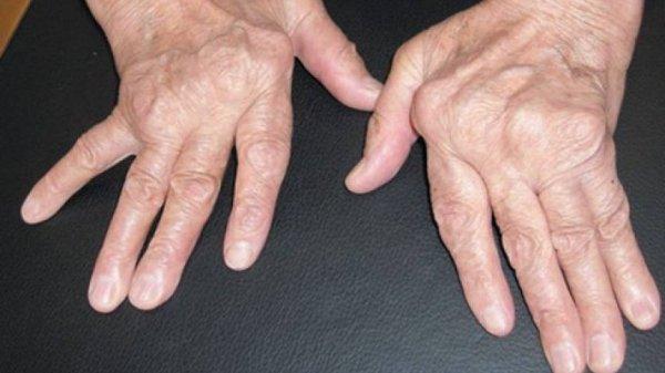 Romatoid artrit nedir