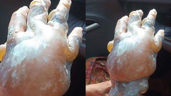 Diş macunu yanıklara iyi gelmiyor