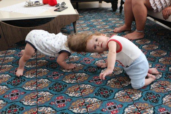 Antalya'da kafadan yapışık siyam ikizleri 1 yaşında