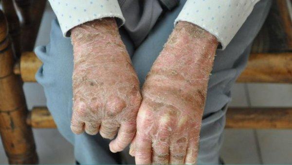 Balık pulu hastalarının ilaç sorunu çözüldü