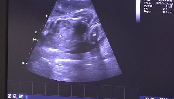 Çekya'da mucizevi doğum