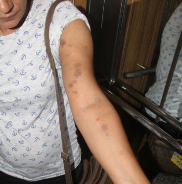 Adanalı kadın birlikte yaşadığı adam tarafından dövüldü