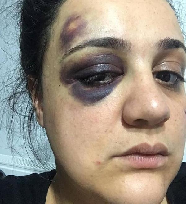 Eşinden dayak yiyen kadın ölümden korkuyor