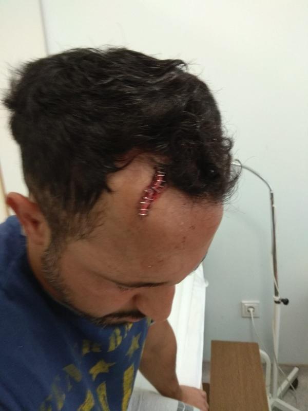 Pendik'te damat kayınpederinin dudağını parçaladı