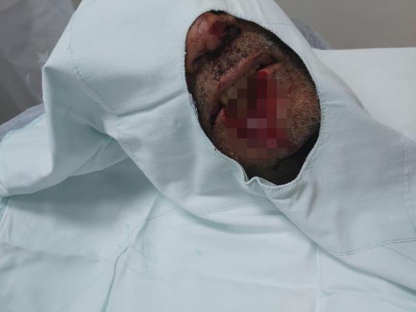 Pendik'te damat kayınpederinin dudağını parçaladı