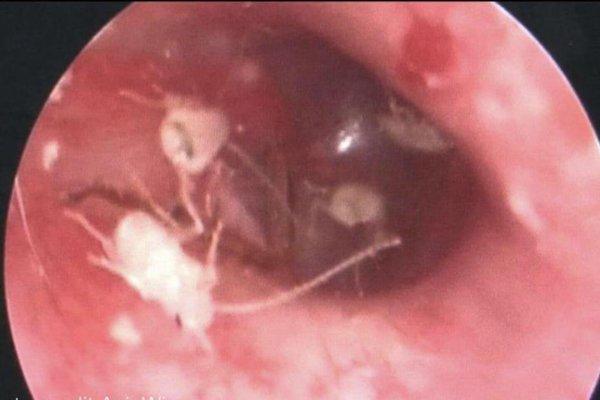 Kulağından 11 hamam böceği çıktı