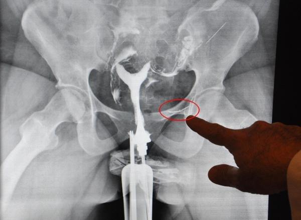 Bodrum'da dikiş iğnesi yutan kadın ameliyat oldu