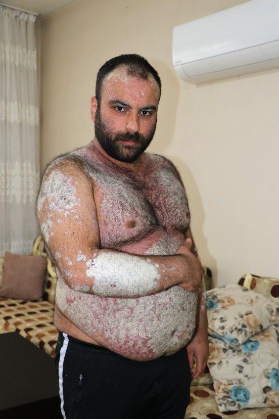 Sedef hastalığına yakalandı, yardım bekliyor