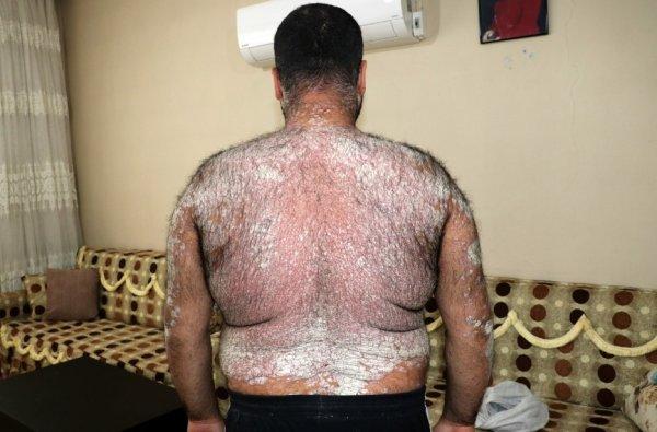 Sedef hastalığına yakalandı, yardım bekliyor