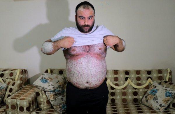 Sedef hastalığına yakalandı, yardım bekliyor