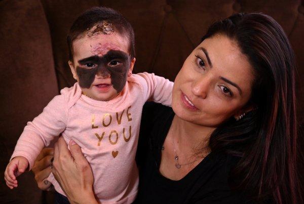 Nadir görülen cilt hastalığı ile doğdu