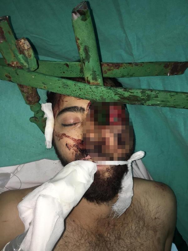 Trafik kazasında yüzüne demir saplandı