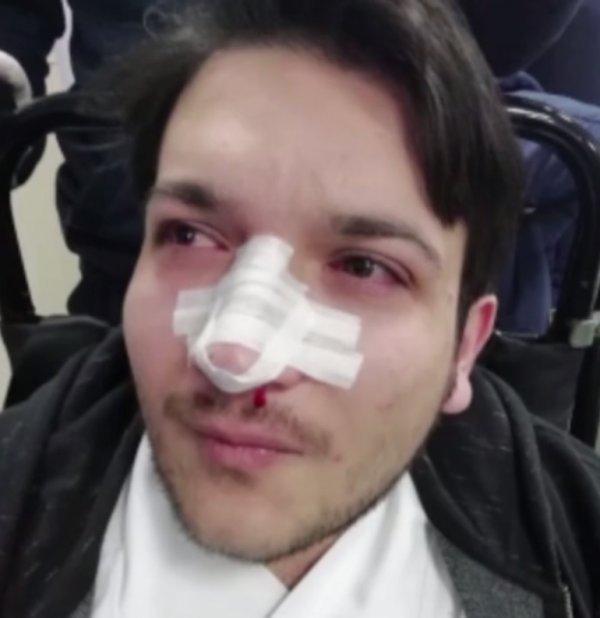 Doktorun burnunu kıran şüpheli teslim oldu