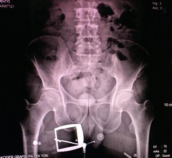 İranlı kadının makatından 124 gram uyuşturucu çıktı
