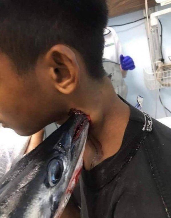 İğne balığı saldırısında bir çocuk yaralandı