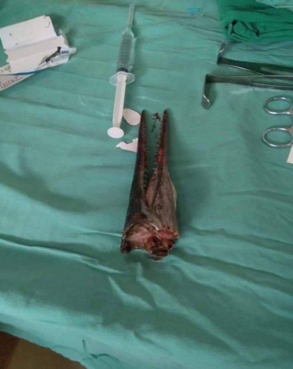 İğne balığı saldırısında bir çocuk yaralandı