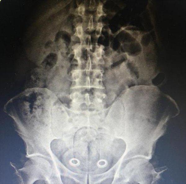 İranlı bir kişinin mide ve bağırsağından uyuşturucu çıktı