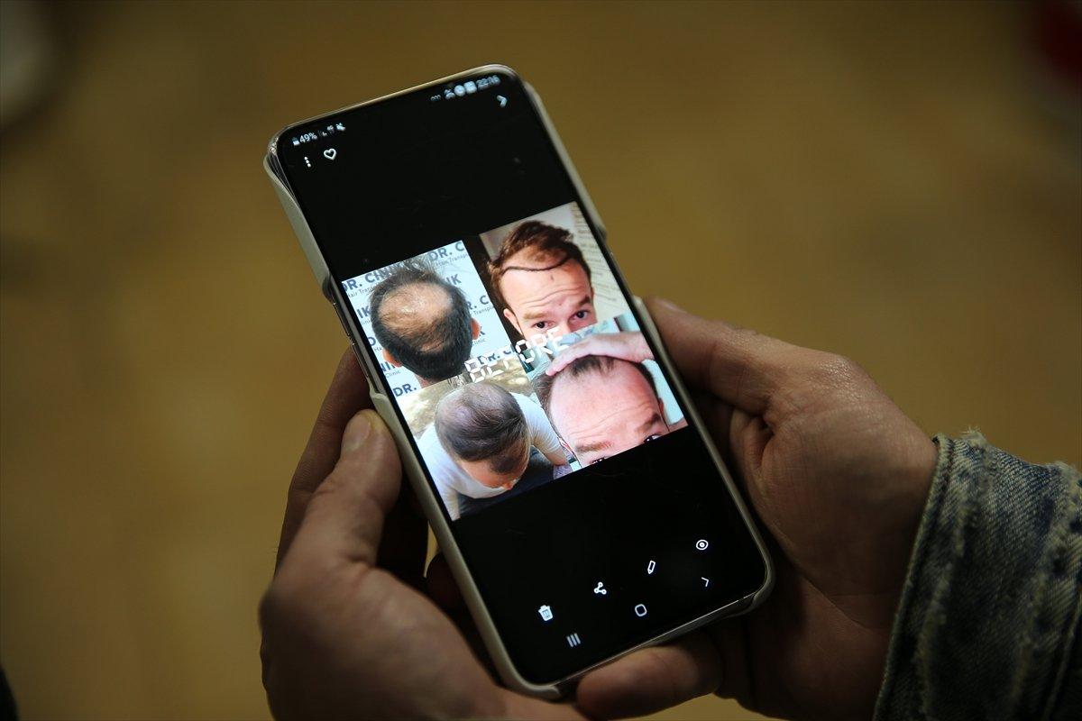 İsrailliler, saç ektirmek için Türkiye'yi tercih ediyor