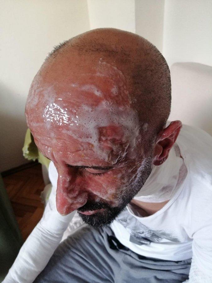 Eyüpsultan'da oto tamircide nitrojen dolu lastik patladı