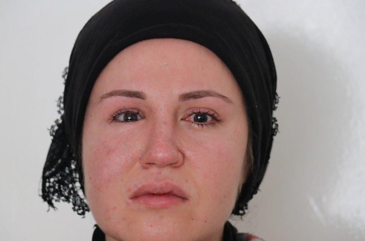 Eşi tarafından vurulan genç kadın gözünü kaybetti