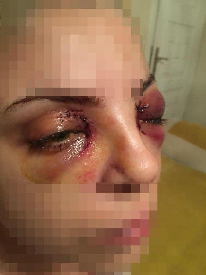 Şizofreni hastasının saldırısına uğrayan kadın konuştu