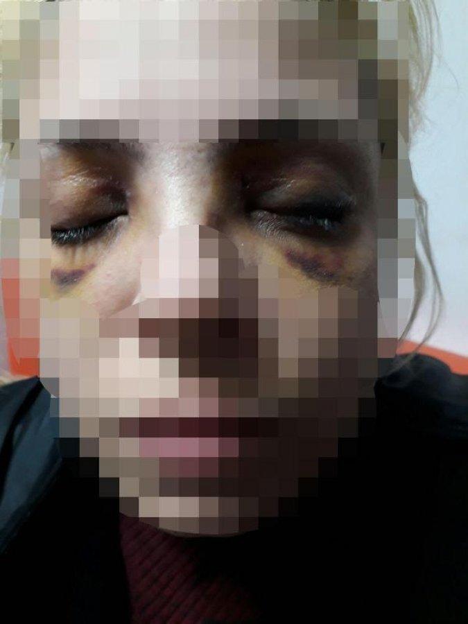 Şizofreni hastasının saldırısına uğrayan kadın konuştu