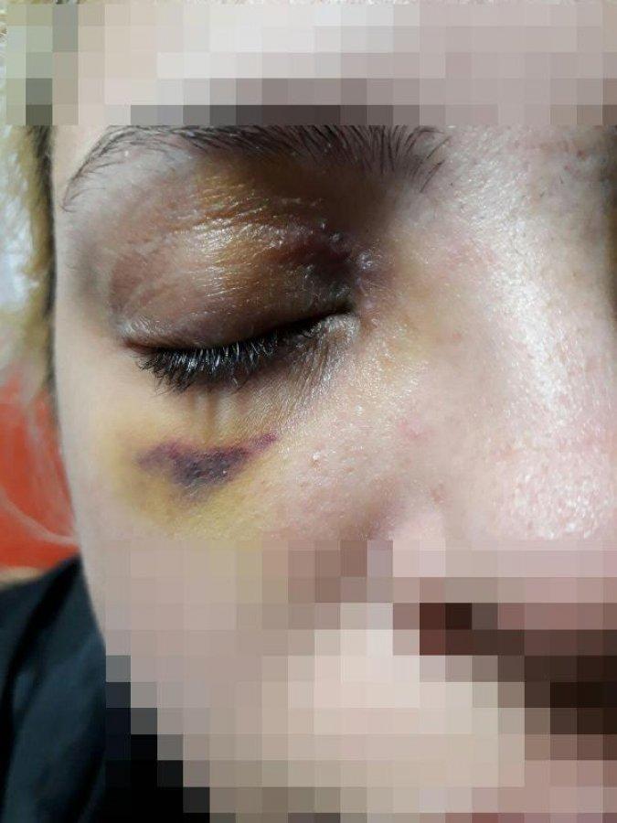 Şizofreni hastasının saldırısına uğrayan kadın konuştu