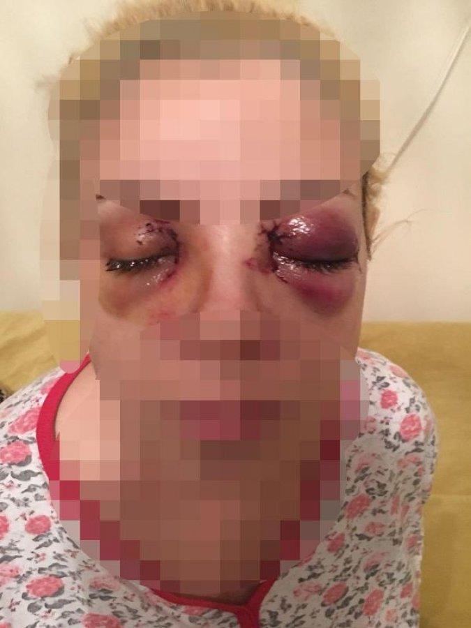 Şizofreni hastasının saldırısına uğrayan kadın konuştu