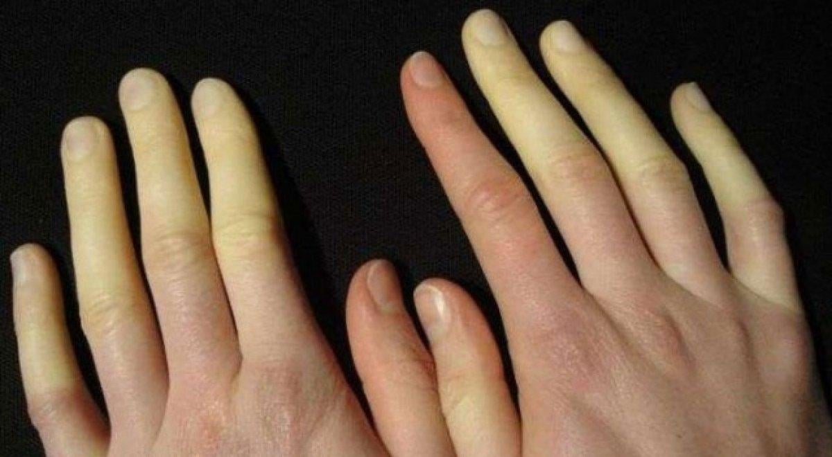 Raynaud fenomeni nedir