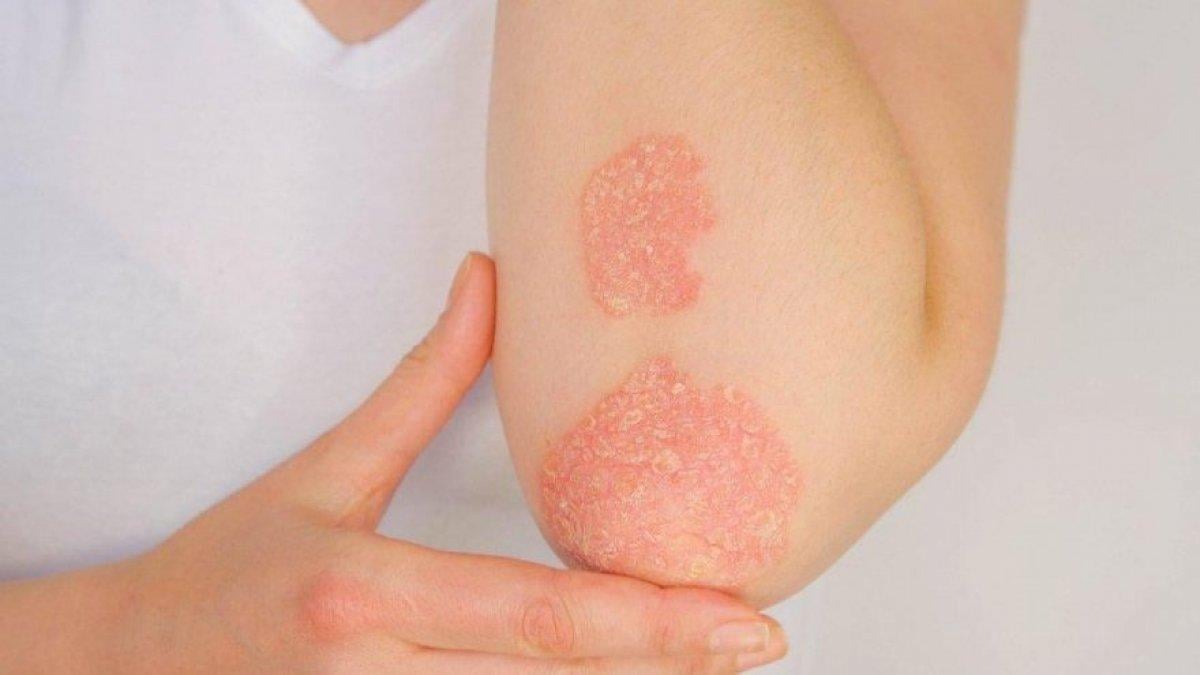 Psoriasis nedir