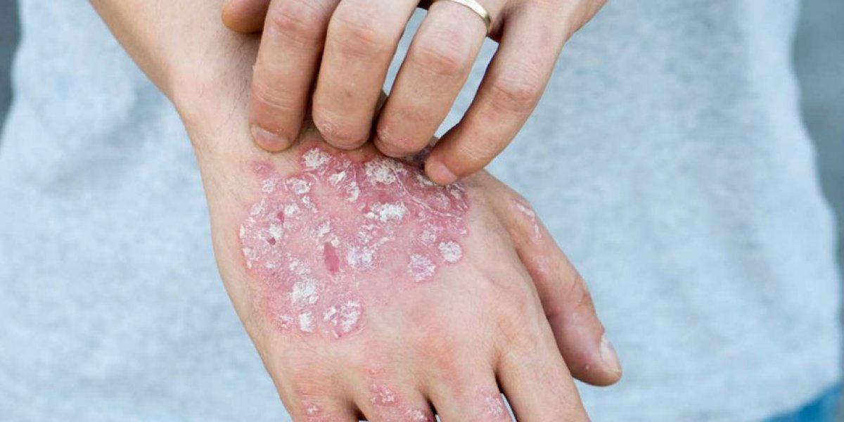 Psoriasis nedir