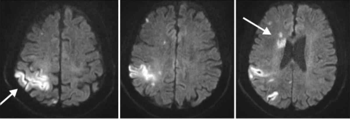 Paramnezi sendromu nedir