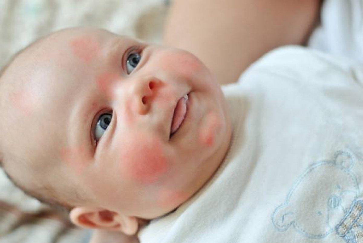 Kawasaki hastalığı nedir