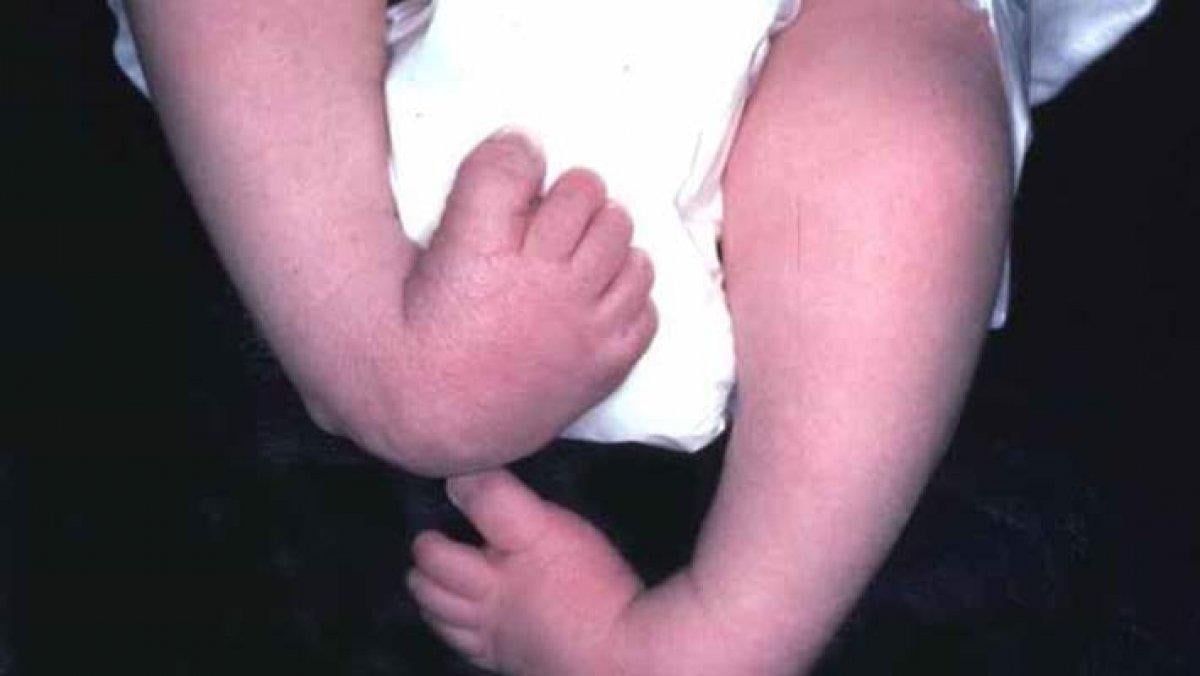 Moebius sendromu nedir