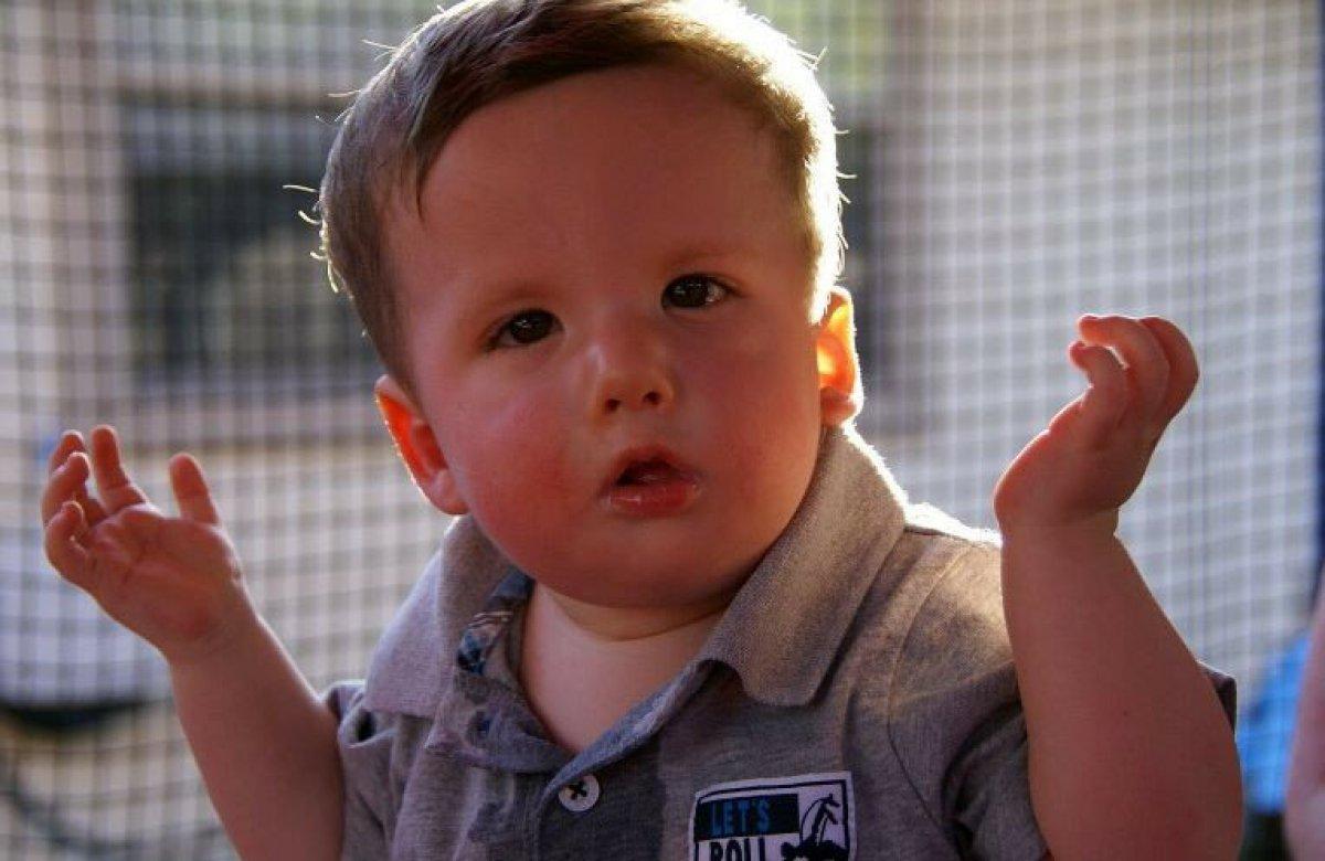 Moebius sendromu nedir